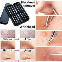 9pcs Stainless Acne Needle Blackhead and Pimple Remover 